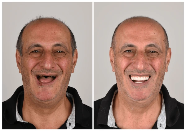 𦷠Nepharn⢠Custom-Fit Functional Dentures š Smile with Confidence