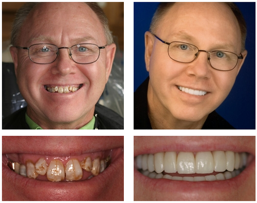 𦷠Nepharn⢠Custom-Fit Functional Dentures š Smile with Confidence