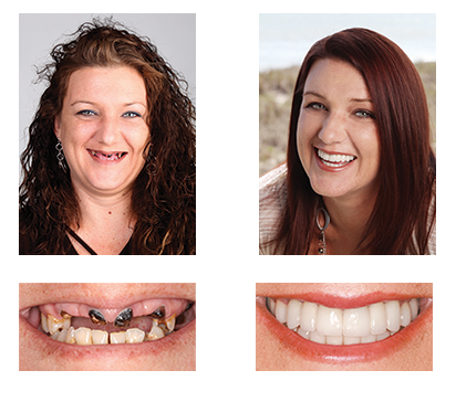 𦷠Nepharn⢠Custom-Fit Functional Dentures š Smile with Confidence