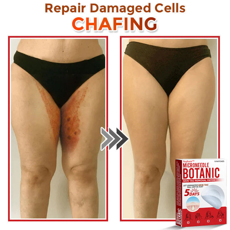 🌈Nepharn™ MicroNeedle Botanic Skin Tag Removal Patch 🇺🇸 Made in the USA