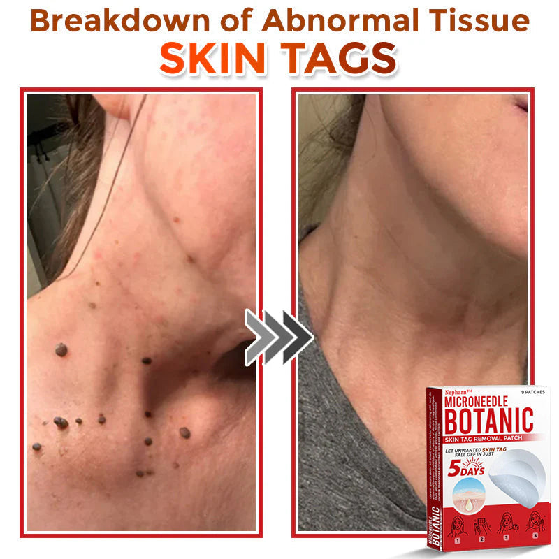 🌈Nepharn™ MicroNeedle Botanic Skin Tag Removal Patch 🇺🇸 Made in the USA