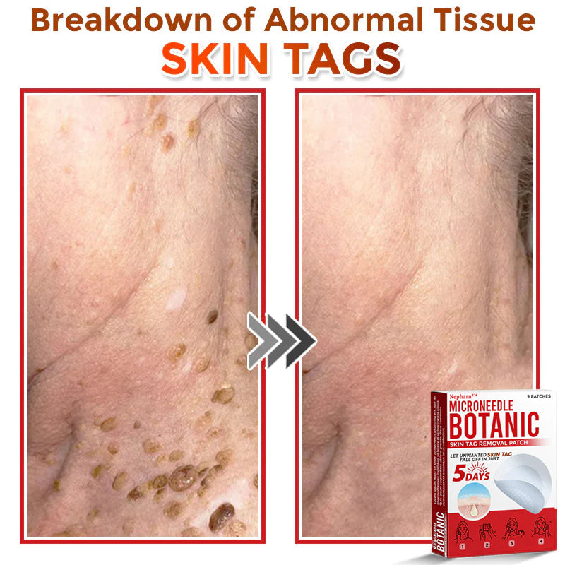 🌈Nepharn™ MicroNeedle Botanic Skin Tag Removal Patch 🇺🇸 Made in the USA