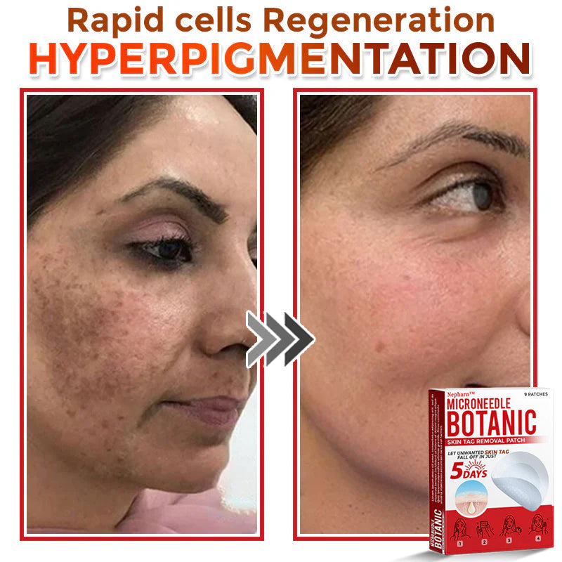 🌈Nepharn™ MicroNeedle Botanic Skin Tag Removal Patch 🇺🇸 Made in the USA
