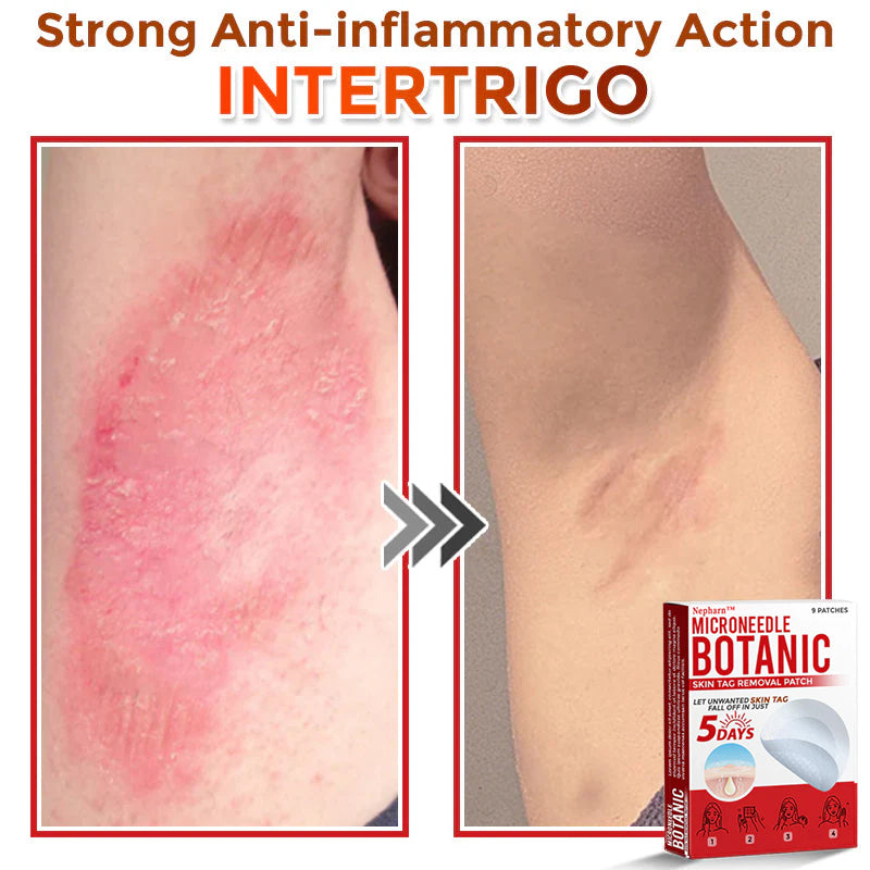 🌈Nepharn™ MicroNeedle Botanic Skin Tag Removal Patch 🇺🇸 Made in the USA
