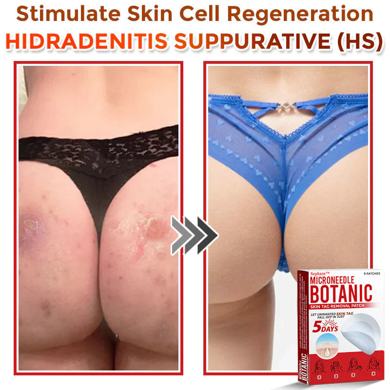 🌈Nepharn™ MicroNeedle Botanic Skin Tag Removal Patch 🇺🇸 Made in the USA