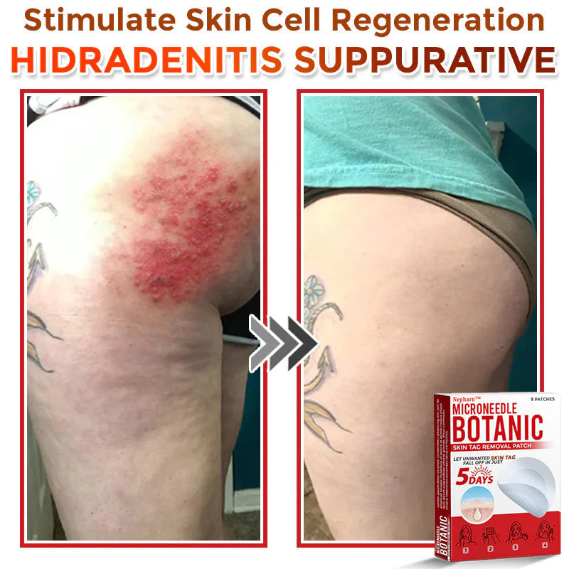 🌈Nepharn™ MicroNeedle Botanic Skin Tag Removal Patch 🇺🇸 Made in the USA