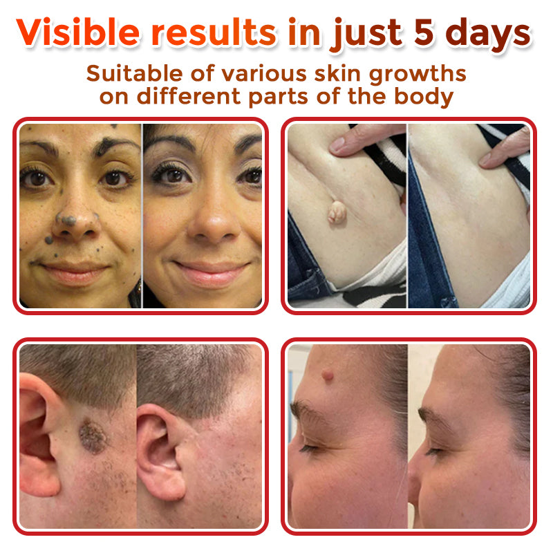 🌈Nepharn™ MicroNeedle Botanic Skin Tag Removal Patch 🇺🇸 Made in the USA