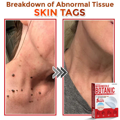 🌈Nepharn™ MicroNeedle Botanic Skin Tag Removal Patch 🇺🇸 Made in the USA
