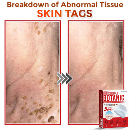 🌈Nepharn™ MicroNeedle Botanic Skin Tag Removal Patch 🇺🇸 Made in the USA