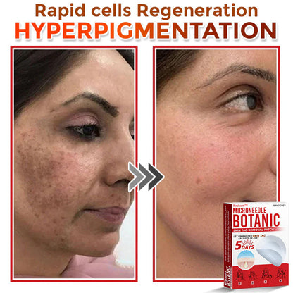 🌈Nepharn™ MicroNeedle Botanic Skin Tag Removal Patch 🇺🇸 Made in the USA