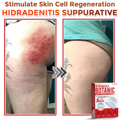 🌈Nepharn™ MicroNeedle Botanic Skin Tag Removal Patch 🇺🇸 Made in the USA